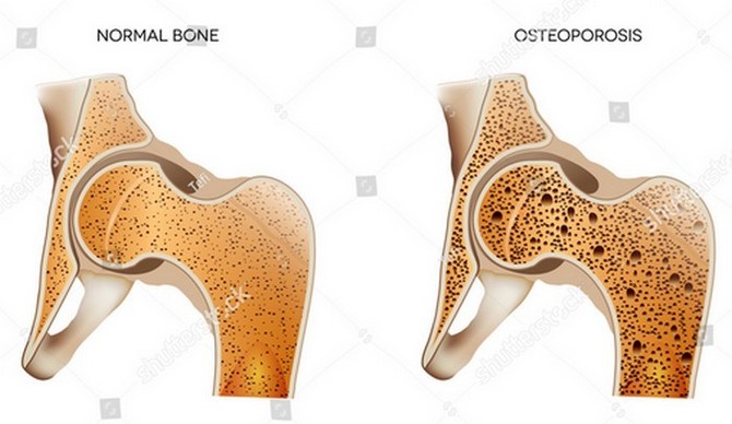 Výrazně náchylnější k osteoporóze jsou ženy